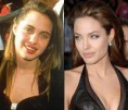 /album/galeria-de-fotos/antes-depois-angelina-jpg/